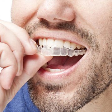 Invisalign®: The Inconspicuous Way to Straighten Your Smile