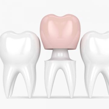 A Detailed Guide to Dental Crowns