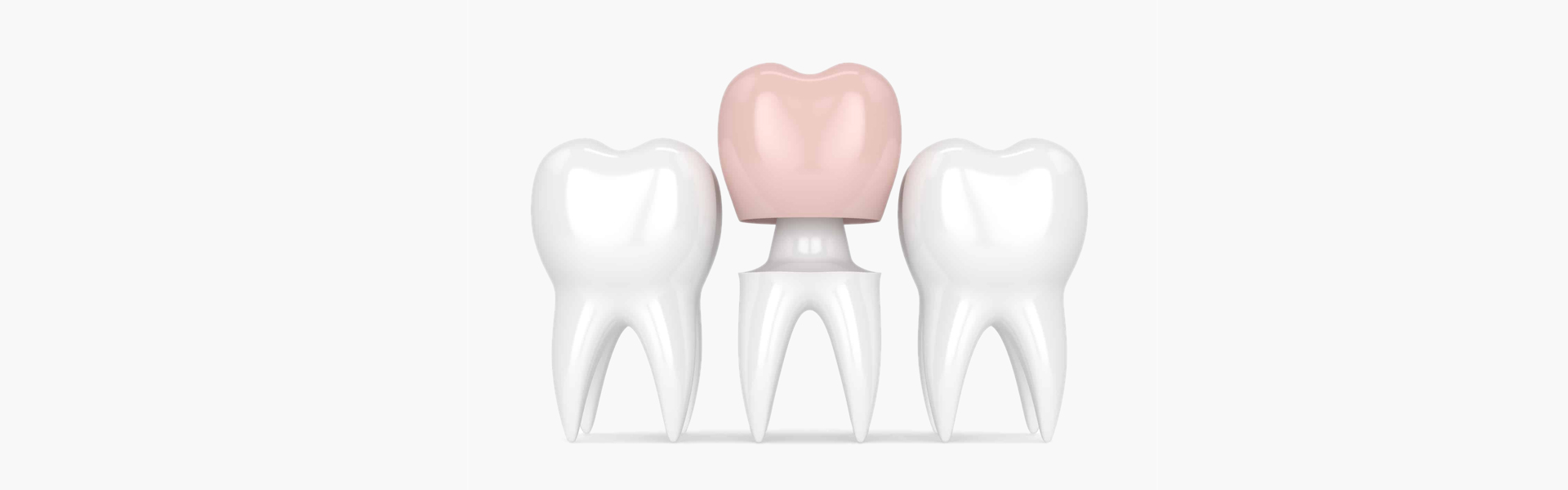 A Detailed Guide to Dental Crowns