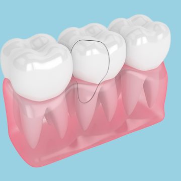 Can a Dental Crown Fix a Cracked or Broken Tooth?